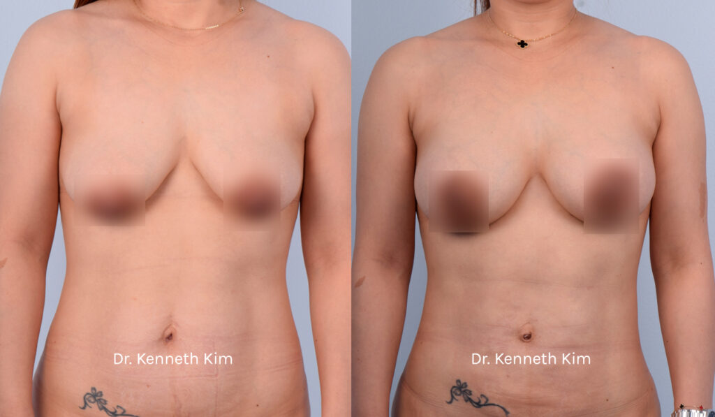 Patient underwent an awake breast lift and augmentation to achieve a fuller and more youthful breast shape. The breast lift (mastopexy) elevated the sagging breast tissue and repositioned the nipples to a higher position. The breast augmentation added volume and fullness to her breast shape. Dr. Kim performs these surgeries using local anesthesia, thereby avoiding the risks associated with general anesthesia and intravenous (IV) sedation, such as blood clots and memory loss. Dr. Kim also performs a 'bloodless' surgery where he meticulously avoids blood vessels, as bleeding causes inflammation and capsular contracture (hardened and distorted breast). Dr. Kim's 'bloodless' technique results in the fastest recovery with minimal to no downtime, no need for prescription opioid medications, and the most natural-looking results. This patient was fully awake during her surgery, experienced no pain or discomfort, and was able to walk out of the operating room unassisted. Most of Dr. Kim's patients resume their normal routines right after surgery. The post-op photos show how the awake procedures restored breast shape and added volume, especially to the upper pole (top part of the breast), creating a rounded and lifted appearance.
   

