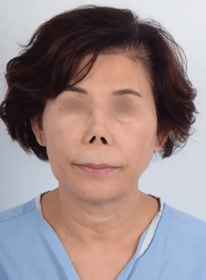 Nose Surgery Before & After Patient #5472
