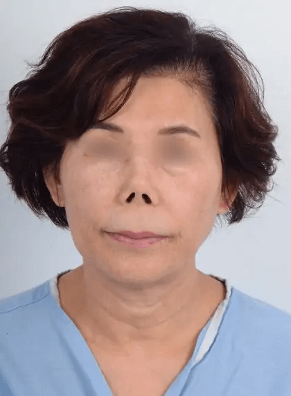 Asian female in her 60s had a significantly upturned and shortened nose following a prior rhinoplasty surgery performed elsewhere. She received revision rhinoplasty with Dr. Kim who used rib cartilage to reconstruct the nose. Dr. Kim used local anesthesia so the patient was awake during the procedure and did not experience pain or discomfort. The after photo shows a drastic transformation from a contracted nose with visible nostrils to a natural-looking and aesthetically pleasing nose, restoring facial balance. She also underwent a lip lift procedure which gently elevated her upper lift and improved lip proportions.