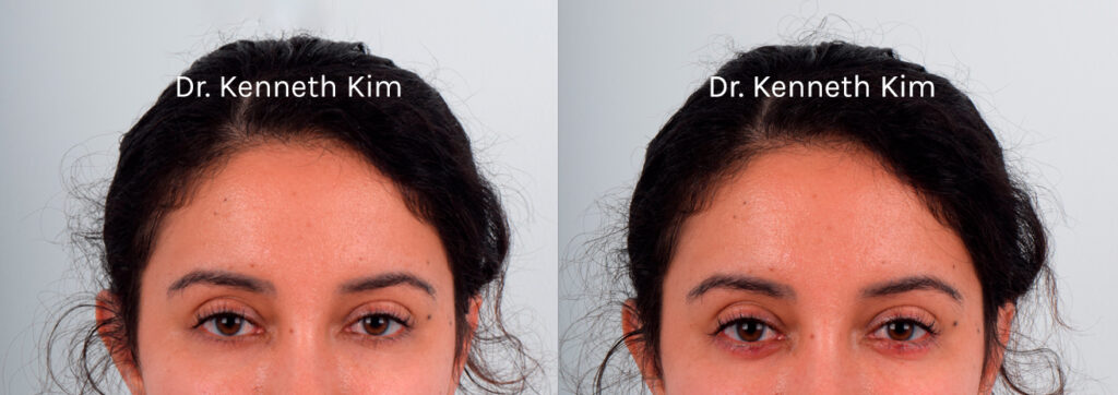 Aegyo-sal is a Korean term used to describe 'cute' fullness in the lower eyelid area, just below the lower lashes. This feature is most noticeable when smiling. This is a sought-after aesthetic in Korea as it denotes youthfulness and charm. Filler injections are a non-invasive way to add this desired volume. The procedure is quick and results are immediate. The 'after' photo was taken immediately after the procedure, so there is some redness present, which will fade shortly. The lower eye fullness (aegyo sal) creates a more youthful appearance and subtly conveys a smiling expression.
   

