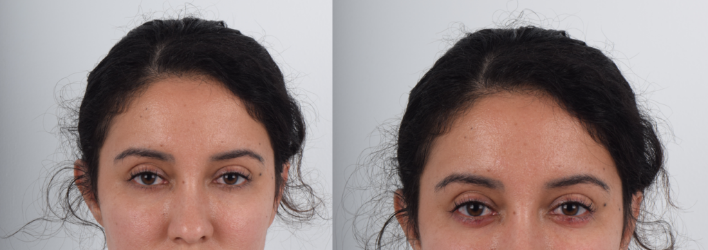 Aegyo-sal is a Korean term used to describe 'cute' fullness in the lower eyelid area, just below the lower lashes. This feature is most noticeable when smiling. This is a sought-after aesthetic in Korea as it denotes youthfulness and charm. Filler injections are a non-invasive way to add this desired volume. The procedure is quick and results are immediate. The 'after' photo was taken immediately after the procedure, so there is some redness present, which will fade shortly. The lower eye fullness (aegyo sal) creates a more youthful appearance and subtly conveys a smiling expression.
   

