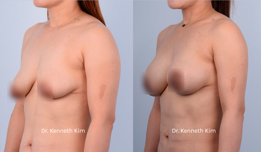 Patient underwent an awake breast lift and augmentation to achieve a fuller and more youthful breast shape. The breast lift (mastopexy) elevated the sagging breast tissue and repositioned the nipples to a higher position. The breast augmentation added volume and fullness to her breast shape. Dr. Kim performs these surgeries using local anesthesia, thereby avoiding the risks associated with general anesthesia and intravenous (IV) sedation, such as blood clots and memory loss. Dr. Kim also performs a 'bloodless' surgery where he meticulously avoids blood vessels, as bleeding causes inflammation and capsular contracture (hardened and distorted breast). Dr. Kim's 'bloodless' technique results in the fastest recovery with minimal to no downtime, no need for prescription opioid medications, and the most natural-looking results. This patient was fully awake during her surgery, experienced no pain or discomfort, and was able to walk out of the operating room unassisted. Most of Dr. Kim's patients resume their normal routines right after surgery. The post-op photos show how the awake procedures restored breast shape and added volume, especially to the upper pole (top part of the breast), creating a rounded and lifted appearance.
   

