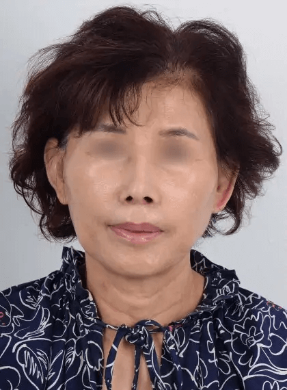 Asian female in her 60s had a significantly upturned and shortened nose following a prior rhinoplasty surgery performed elsewhere. She received revision rhinoplasty with Dr. Kim who used rib cartilage to reconstruct the nose. Dr. Kim used local anesthesia so the patient was awake during the procedure and did not experience pain or discomfort. The after photo shows a drastic transformation from a contracted nose with visible nostrils to a natural-looking and aesthetically pleasing nose, restoring facial balance. She also underwent a lip lift procedure which gently elevated her upper lift and improved lip proportions.