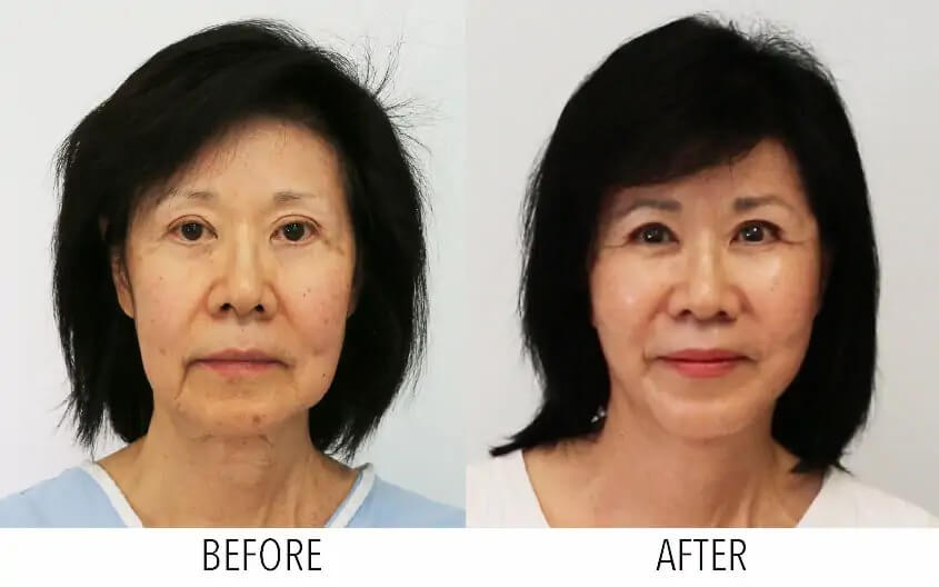 before-image