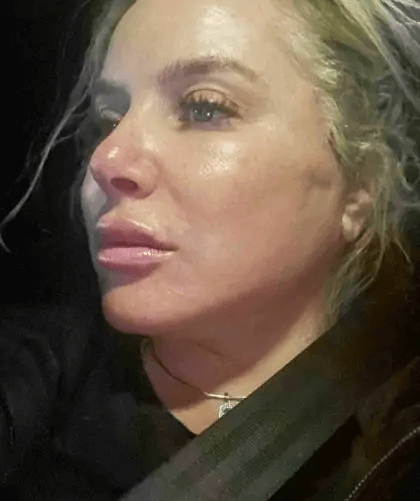 Facelift Before & After Patient #5351