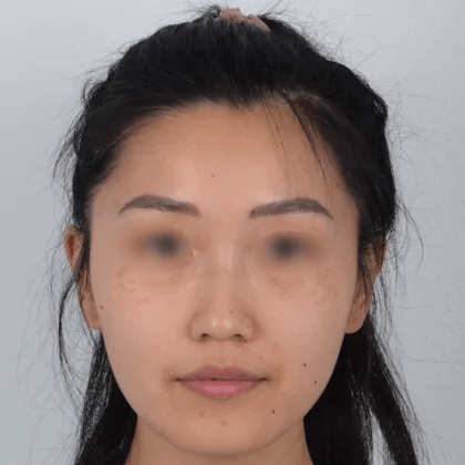 Nose Surgery Before & After Patient #5127