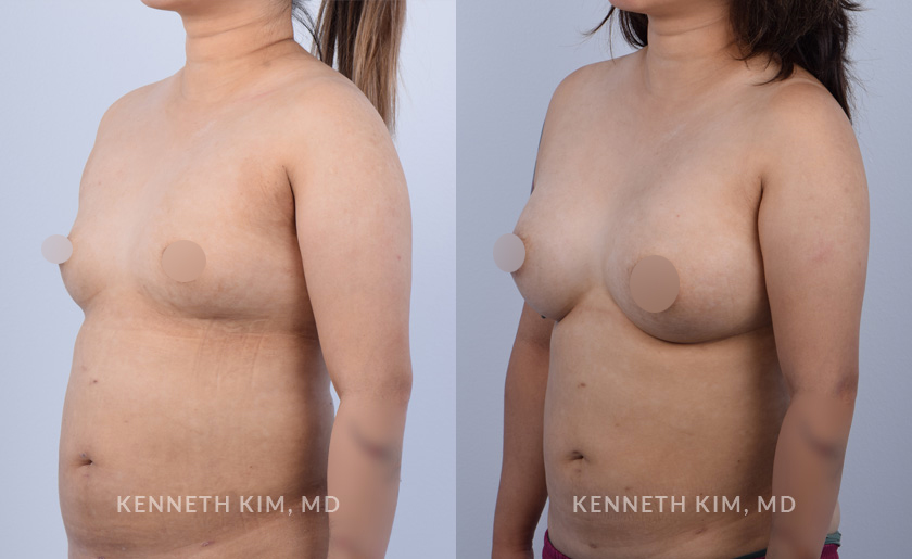 breast-aut-before-and-ater-2-