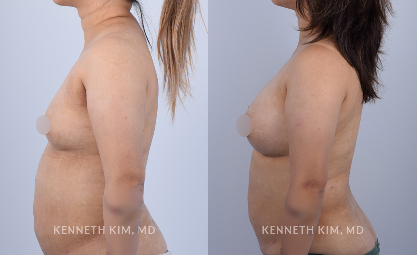 breast-aut-before-and-ater-3-