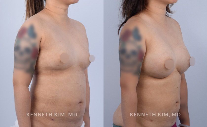 breast-aut-before-and-ater-4-