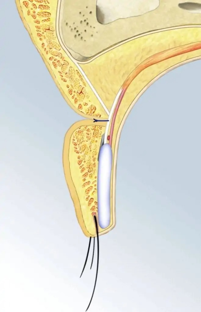 high suture fix sketch image