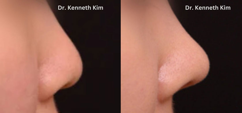 Young female Asian patient’s results after minor nose reshaping performed by awake rhinoplasty surgeon. Note subtle lifting of the nose tip to create a defined profile.