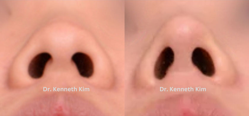 Young female Asian patient’s results after minor nose reshaping performed by awake rhinoplasty surgeon. Note subtle lifting of the nose tip to create a defined profile.