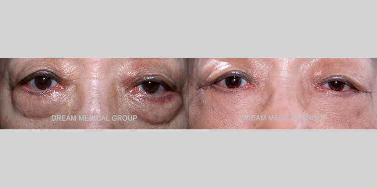 Female Asian patient in her 60s had significant under-eye bags and puffiness. The awake lower blepharoplasty (lower eyelid surgery) successfully tightened and smoothed the lower eye region. The after photo shows the dramatic improvement and transformation from fatigued and older appearing eyes to a refreshed and rejuvenated look. The patient received awake surgery with no pain or discomfort that resulted in the fastest recovery possible.