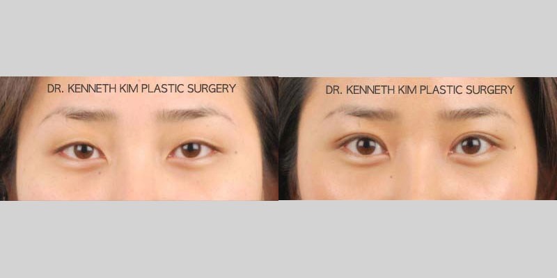 Results for a female patient in her 20s following an awake double eyelid revision and eyelid ptosis correction to make her eyes appear bigger. The after photo shows defined double eyelid folds that enhance her eye shape and make her eyes appear naturally larger.