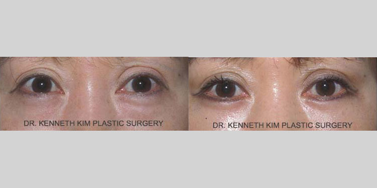 Awake lower eyelid surgery results for a female Asian patient in her 50s. The lower blepharoplasty procedure involved repositioning the fat in the lower eyelid to reduce the under-eye bags/bulge. Note the smoother, more taut contour of the lower eye region in the after photo.