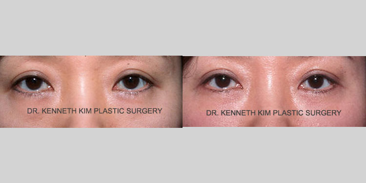 Asian female in her 40s had puffy under-eye bags that made her appear tired and older. She underwent lower eyelid surgery (lower blepharoplasty) where the fat in the lower eyes was repositioned. The after photo shows a smoother lower eye contour where the fat bulge or puffy eye bags are no longer visible, giving a more youthful and rested appearance