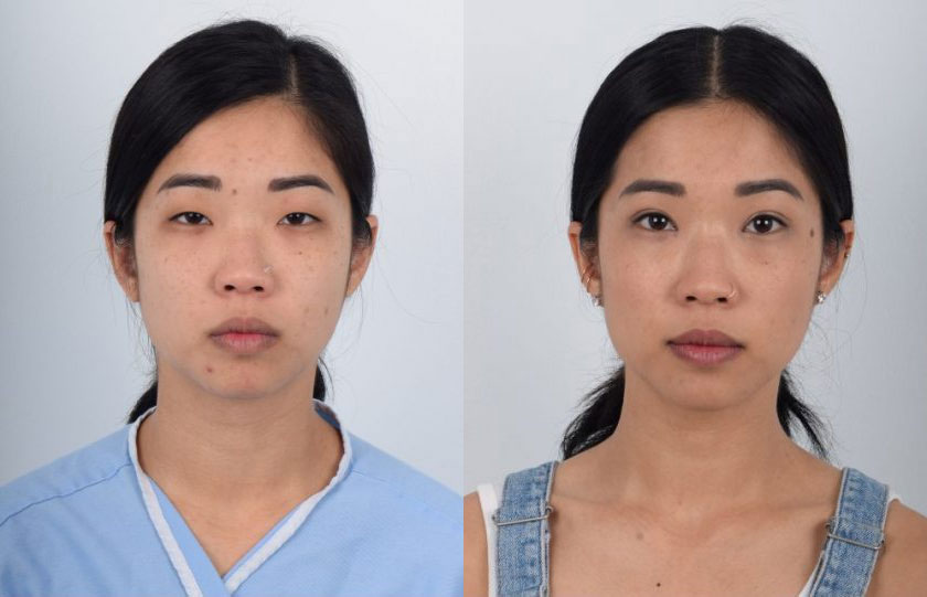 Asian female in her 20s with monolid eyes and ptosis (droop eyelid) underwent Asian double eyelid surgery (Asian blepharoplasty) and ptosis correction. The ptosis repair helped strengthen the weak eye elevating muscle and the double eyelid procedure created defined, balanced double eyelid folds. The after photo shows the transformation from eyes that appeared sleepy and tired to larger and refreshed.