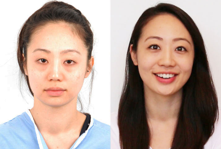 Asian female in her 20s wanted larger eyes with double eyelid creases. She had eyelid ptosis (droopy eyelid) which is a condition characterized by weakness in the eye elevating muscle. For patients with ptosis who are seeking double eyelid surgery, it is imperative that they receive ptosis correction surgery to achieve optimal double eyelid results. This patient had ptosis repair which helped strengthen the eye elevating muscle and Asian double eyelid surgery (Asian blepharoplasty) that created natural-looking, defined double eyelid folds. The after photo shows the transformation from tired and sleepy eyes to a bright and energized appearance.