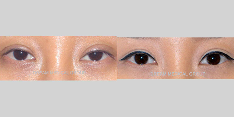 Eyelid Surgery Patient-24