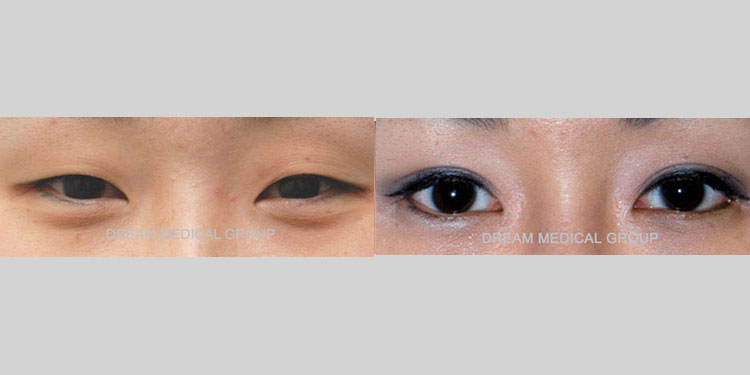 Eyelid Surgery Patient-25
