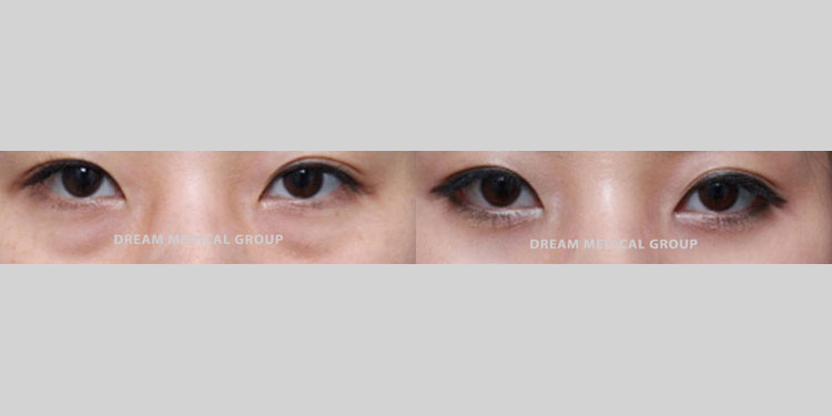 Eyelid Surgery Patient-26