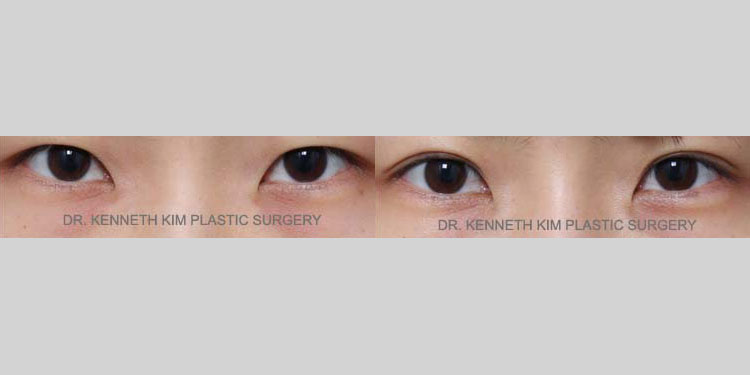 Eyelid Surgery Patient-27