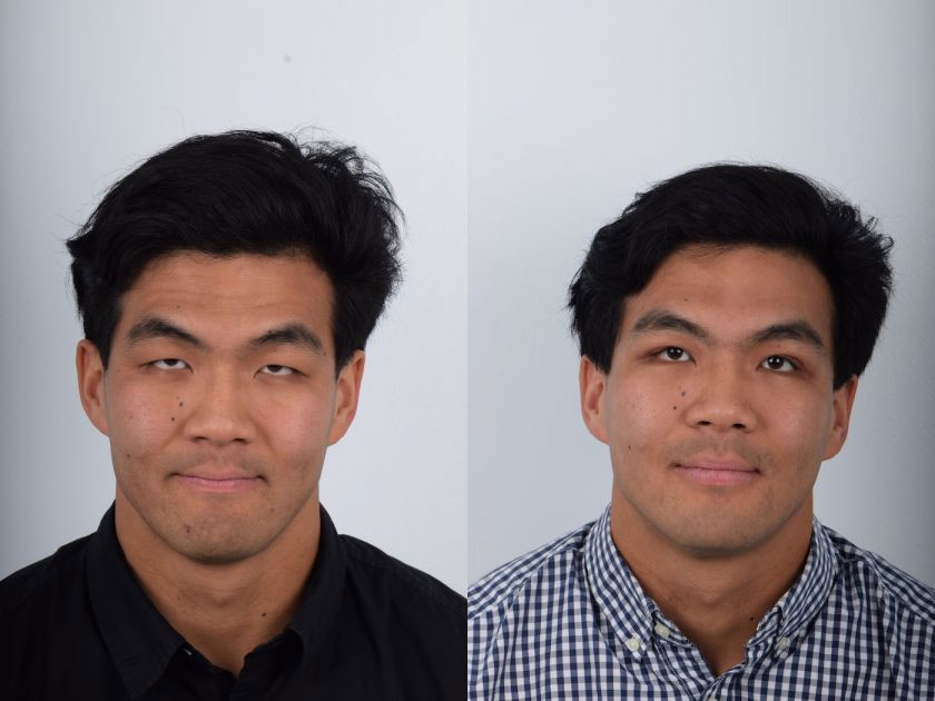 Asian male in his 20s had eyelid ptosis which is a condition where the eye elevating muscle is weak, causing the upper eyelid to droop which can restrict or impair vision. The eye elevating muscle is responsible for raising the eyelid, so a patient with ptosis will have difficulty opening their eyes and will compensate by raising their forehead. In the before photo, you can note forehead wrinkles as the patient is attempting to open their eyes wider with their forehead muscles. This patient underwent ptosis correction and Asian double eyelid surgery (Asian blepharoplasty). The ptosis repair helped strengthen the eye elevating muscle and the Asian blepharoplasty created double eyelid folds. The after photo shows improved eyelid elevation without forehead strain and larger, brighter eyes where the iris is more visible