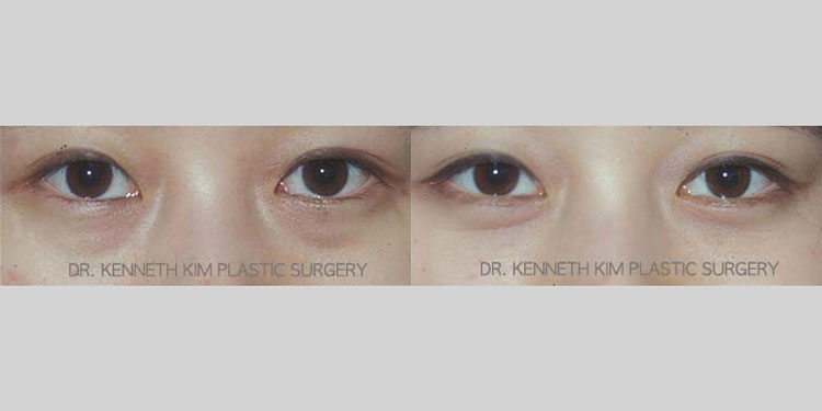 Female patient in her 30s wanted to correct the under-eye dark circles and puffiness that made her look very tired. She received awake lower eyelid surgery (lower blepharoplasty) under local anesthesia. Note the smooth lower eye contour and even complexion in the after photo where she appears refreshed and radiant.