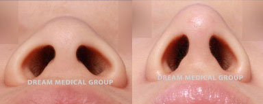 Results of female rhinoplasty showing improvement from flattened nose for a more distinct profile. Entire nose procedure was an awake surgery, improving safety and recovery.