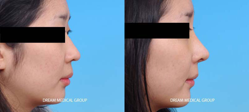 Female patient’s results after Asian nose reshaping, enhancing and elevating nasal tip with cartilage from drooping position for a livelier appearance.