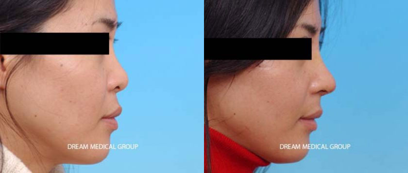 Female patient in her 30s showing results of cartilage rhinoplasty. Only local anesthetic was required, allowing for an awake nose procedure and more rapid healing, resulting in a pleasantly shaped nose profile.