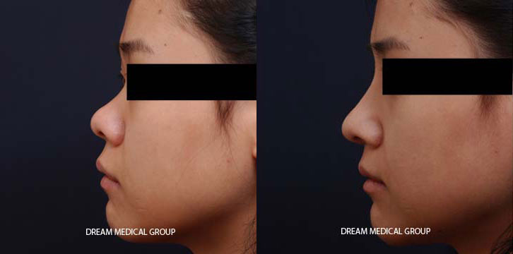 Female patient in late 20s with awake nose surgery for a more balanced nose angle. Quick recovery led to a beautiful nose shape.