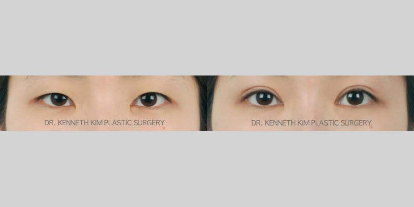 Patient in her early 20s after awake Asian double eyelid surgery. The balanced, natural-looking double eyelid folds made her eyes appear larger and added depth to the eyes. The awake procedure allowed for the fastest recovery.