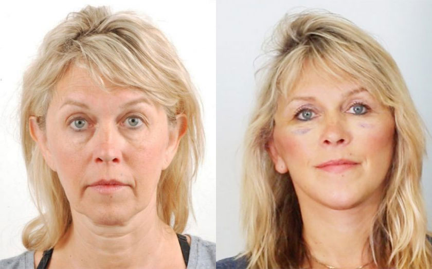 Facelift Before & After Patient #5035