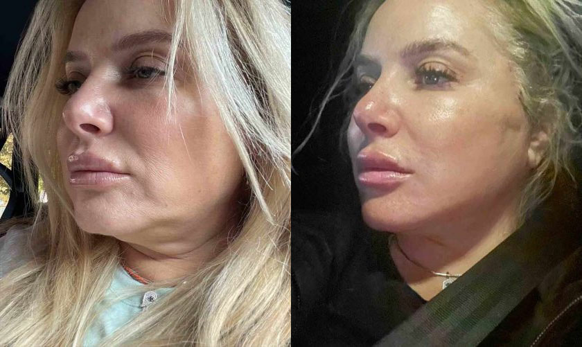 Facelift Before & After Patient #5351