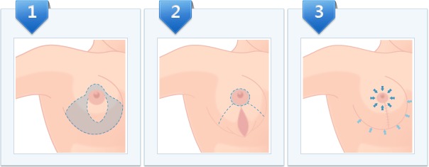 Breast Reduction sketch image