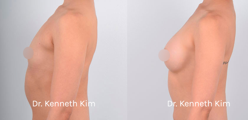 Choi-Breast-Aug-12--