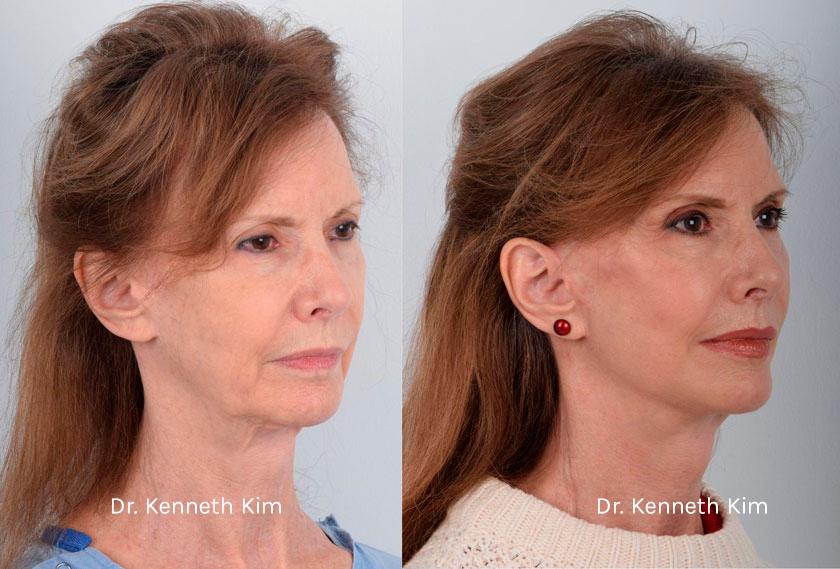 Facelift and Neck Lift