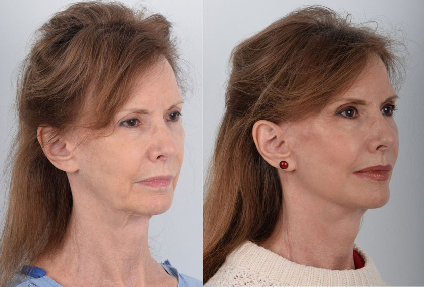 Facelift Before & After Patient #5351
