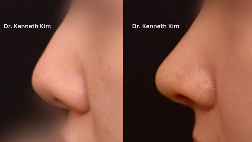 Cartilage repurposing for nose surgery for female Asian patient, results achieved using closed awake rhinoplasty techniques for increased safety and shortened recovery.