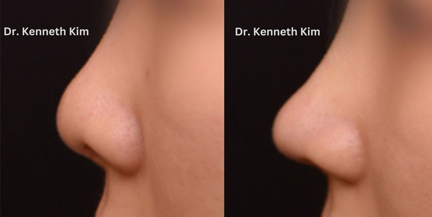 Results for Asian nose reshaping, performed by a rhinoplasty surgeon who is an expert in awake procedures. Subtle nose tip enhancement and balancing nostril symmetry.
