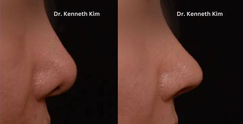 Female patient’s awake rhinoplasty results showing decreased nostril visibility and enhanced profile shape, milder nose tip, and less rounded columella.