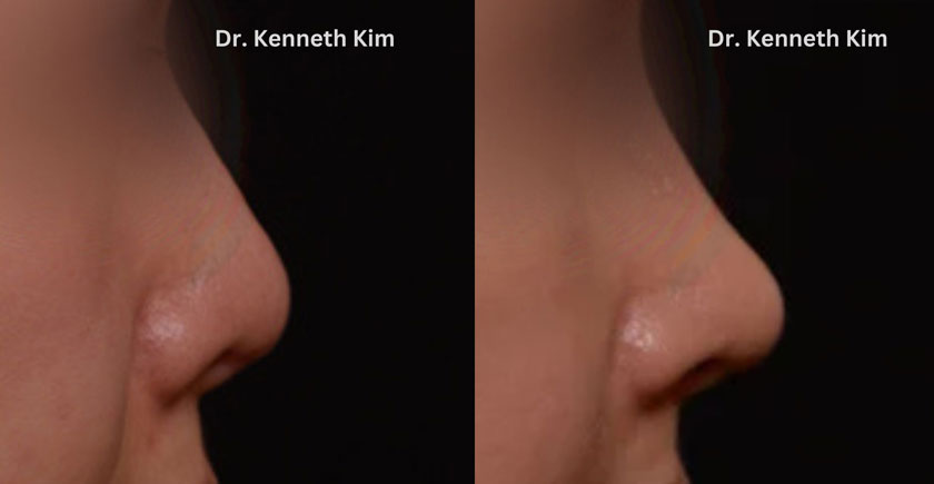 Before and after photos of Asian nose reshaping showing change from flatter, wider nose to a narrower and more pronounced shape to nasal profile.