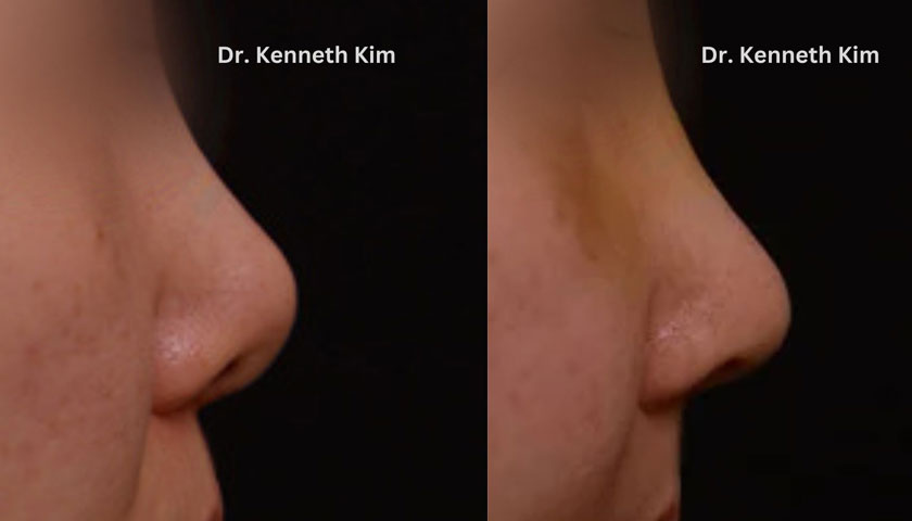 Before and after nose surgery focusing on decreasing nose curve and bringing down the nose tip to a lower position with less nostril visibility.