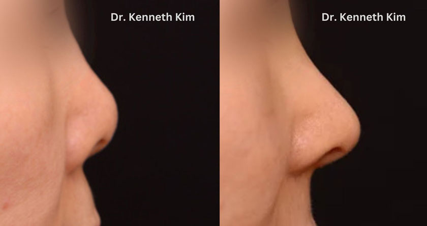 Nose reshaping before and after results for Asian patient with cartilage reposition to bring definition to a flatter nose for a refined profile and decreased nostril visibility.