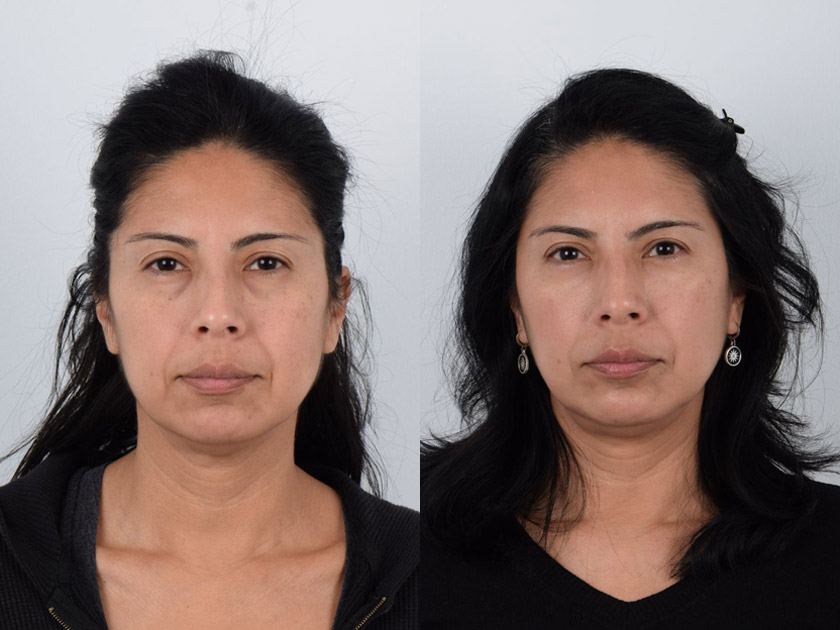 Female in her 40s had puffy under-eye bags and dark circles giving a tired and fatigued appearance. She received lower eyelid surgery (lower blepharoplasty) where the fat in the lower eyelids was repositioned. Note the after photo where the lower eyelid area is smooth without any bulge and dark shadows are no longer visible. The procedure resulted in a brighter and youthful appearance.