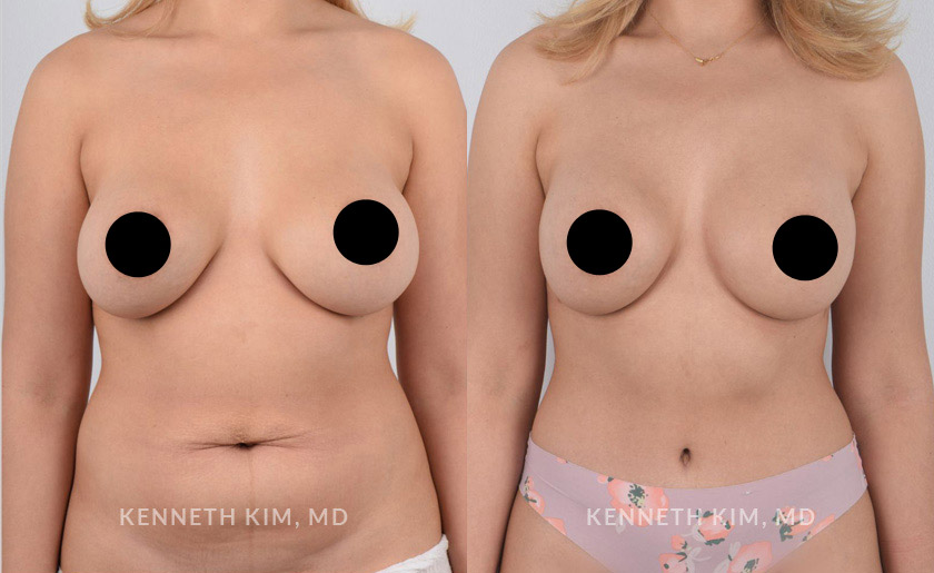 Female in her 30s underwent a mommy makeover which included breast augmentation and tummy tuck surgeries. Note the after photos were taken 3 months after surgery. The breast augmentation elevated the breasts creating a perkier, fuller, and more youthful shape. The tummy tuck (abdominoplasty) reshaped the abdominal area creating a toned and flat stomach.