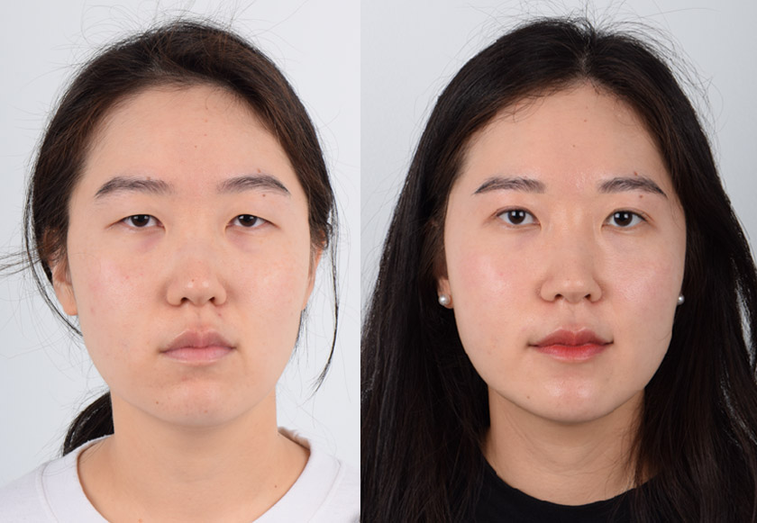 Asian female in her 20s underwent double eyelid surgery (Asian blepharoplasty) and ptosis surgery. The ptosis repair helped strengthen the weak eye elevating muscle which was making her appear tired. The double eyelid procedure created subtle, natural-looking double eyelid folds. The after photo shows a refreshed and brighter appearance.