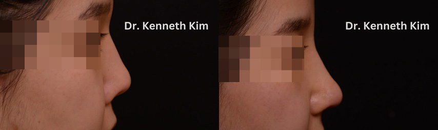 Female aesthetic nose surgery results showing a change from a flat nose profile to a defined nose tip and less visible nostrils from the front.