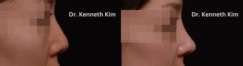 Nose reshaping results showing reshaping of rounded bridge with a hump to a straight one with refined tip, all performed using only local anesthetic.